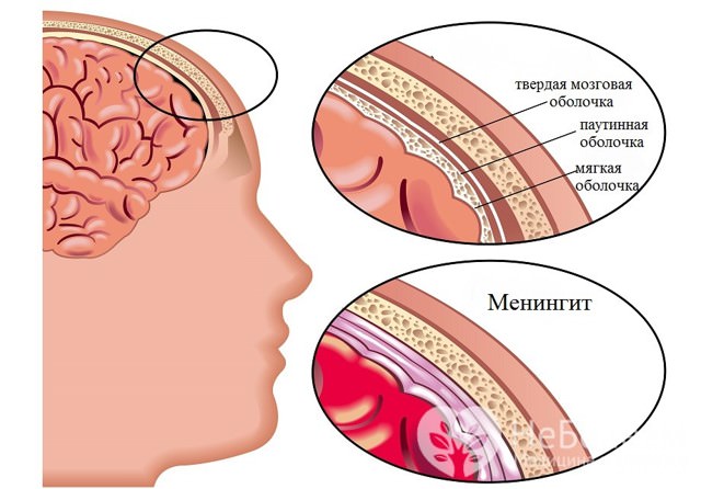 Гнойный менингит у детей: 5 факторов развития