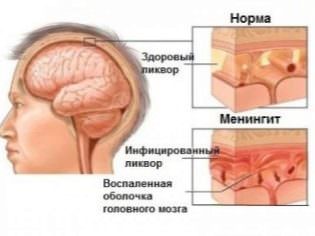 Гнойный менингит у детей: 5 факторов развития