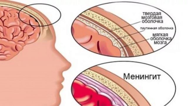 Гнойный менингит у детей: 5 факторов развития