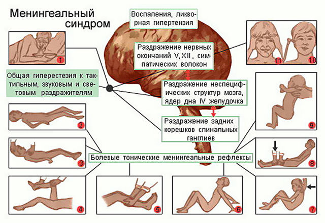 Гнойный менингит у детей: 5 факторов развития