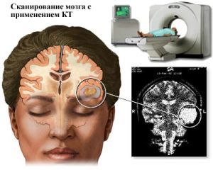 Головная боль: виды, причины, методы лечения мигрени, кластерной боли, гбн