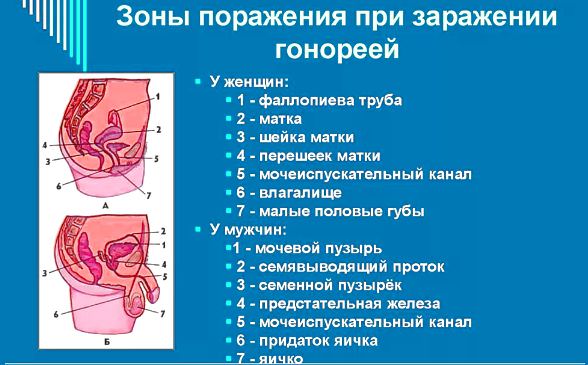Гонорея &mdash; причины, симптомы, как вылечить гонорею, осложнения, профилактика