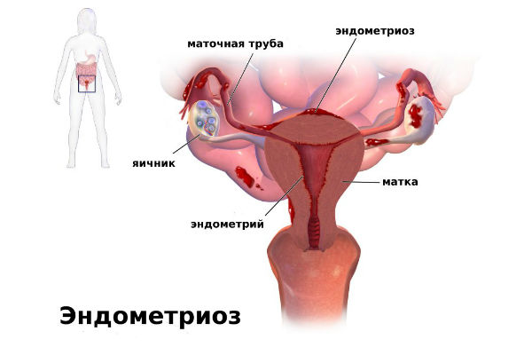 Гормональный препарат визанна: применение во всех фазах менопаузы