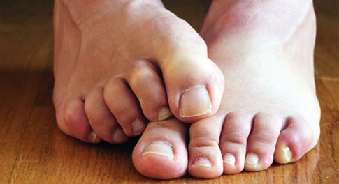 Грибковые заболевания кожи (микозы) лечение народными средствами / народная медицина