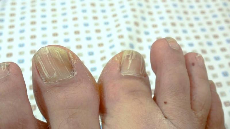 Грибковые заболевания кожи (микозы) лечение народными средствами / народная медицина