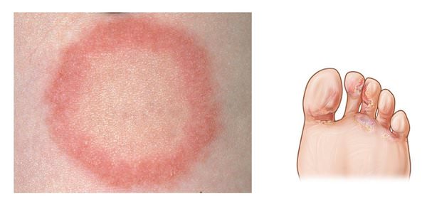 Грибковые заболевания кожи (микозы) лечение народными средствами / народная медицина