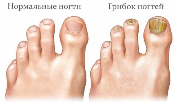 Грибковые заболевания ногтей – народные средства и методы / народная медицина
