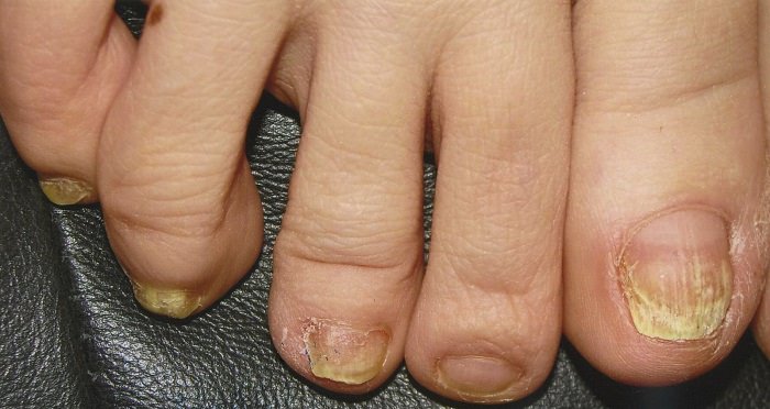 Грибок ногтей. лечение и основные принципы