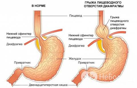 Грыжа пищевода &mdash; симптомы, лечение, осложнения, диета