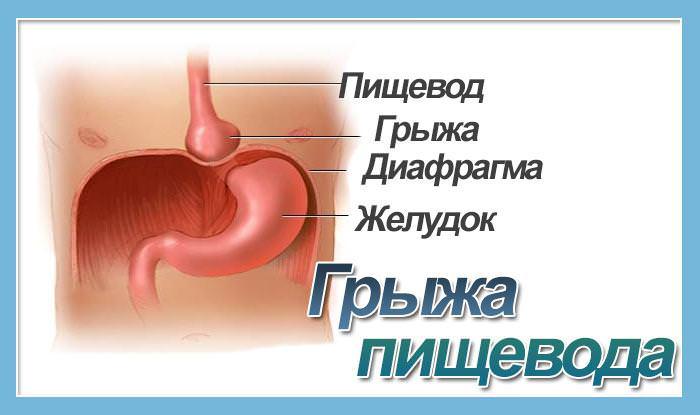 Грыжа пищевода &mdash; симптомы, лечение, осложнения, диета