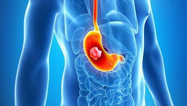 Грыжа пищевода &mdash; симптомы, лечение, осложнения, диета