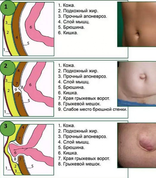 Грыжа пупочная у взрослых &mdash; причины, симптомы, лечение