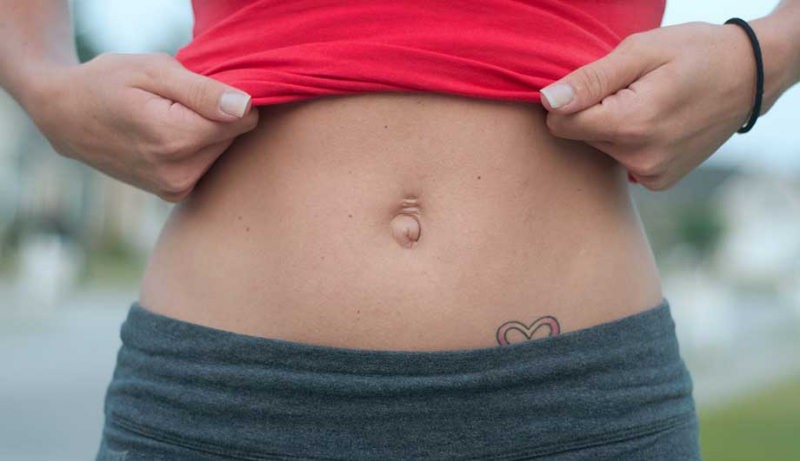 Грыжа пупочная у взрослых &mdash; причины, симптомы, лечение