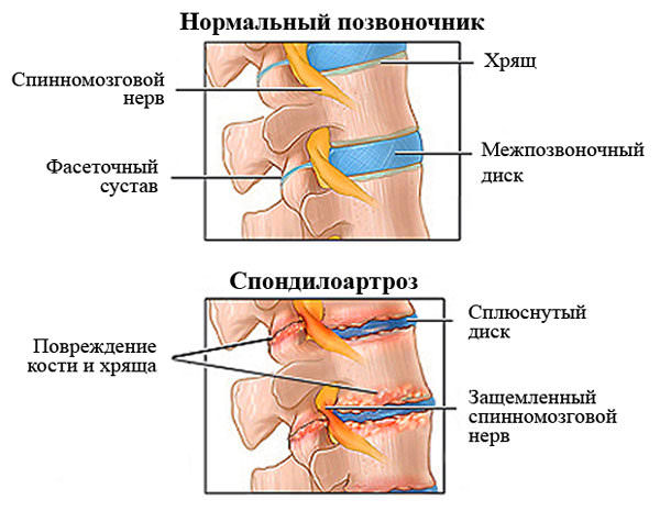 Грыжа шморля в поясничном отделе позвоночника &mdash; симптомы, лечение