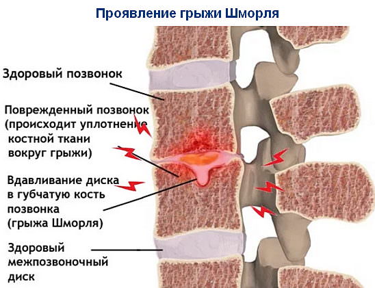 Грыжа шморля в поясничном отделе позвоночника &mdash; симптомы, лечение