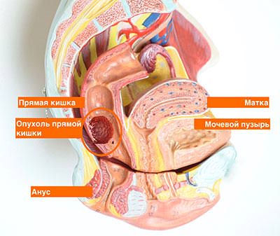 Химиотерапия как метод лечения рака прямой кишки