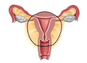 Хирургический климакс после удаления яичников и матки