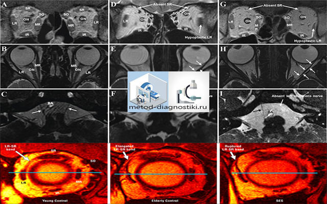 Hrt зрительного нерва (томография), мрт глазных орбит, окт диагностика
