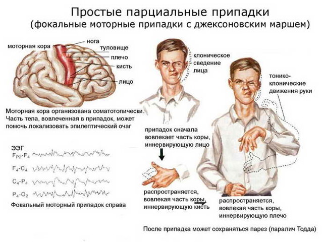 Идиопатическая эпилепсия с генерализованными судорожными приступами