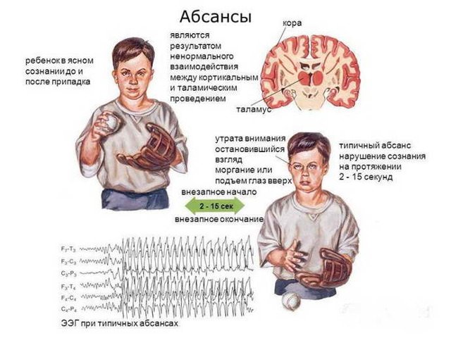 Идиопатическая эпилепсия с генерализованными судорожными приступами