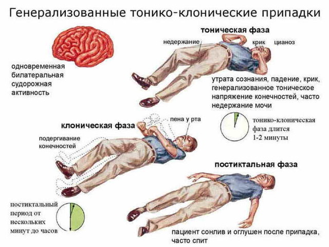 Идиопатическая эпилепсия с генерализованными судорожными приступами