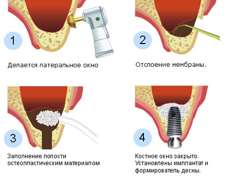 Имплантация зубов: виды операций, типы имплантов, показания и противопоказания