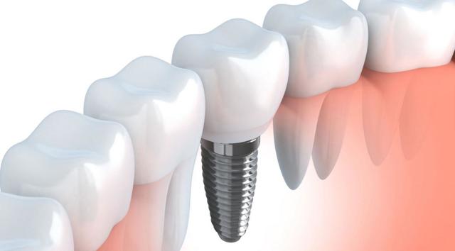 Имплантация зубов: виды операций, типы имплантов, показания и противопоказания