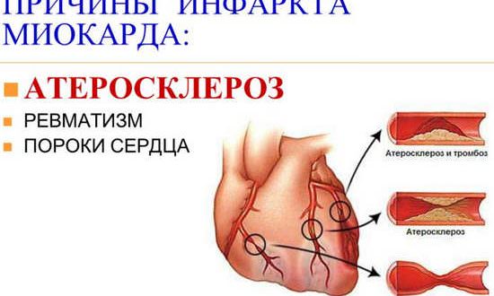 Инфаркт миокарда, причины, симптомы, первая помощь