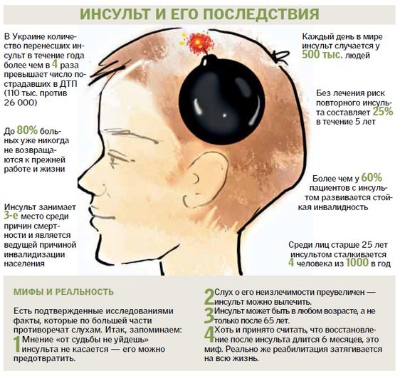 Инсульт и парализация левой стороны, последствия и лечение