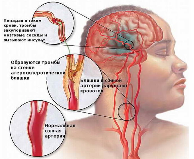 Инсульт и парализация левой стороны, последствия и лечение