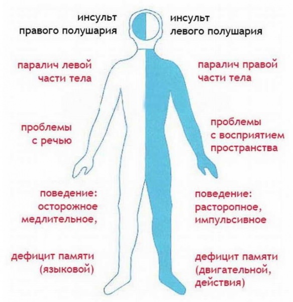 Инсульт и парализация левой стороны, последствия и лечение