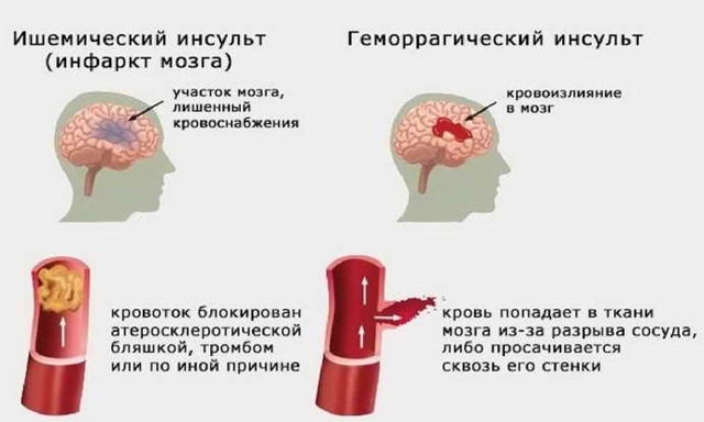 Инсульт и парализация левой стороны, последствия и лечение