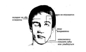 Инсульт и парализация левой стороны, последствия и лечение