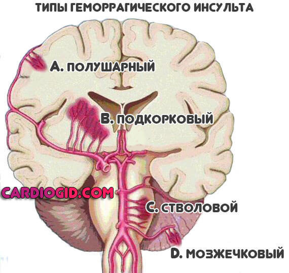 Инсульт: парализация правой стороны, последствия и лечение