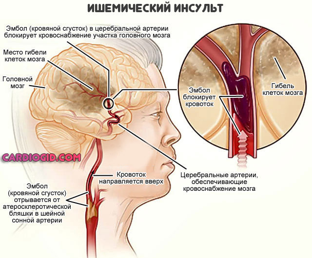 Инсульт: парализация правой стороны, последствия и лечение