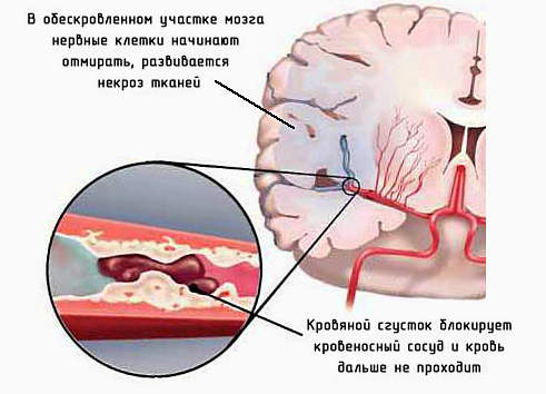 Инсульт &mdash; первые признаки, восстановление после инсульта (онмк)