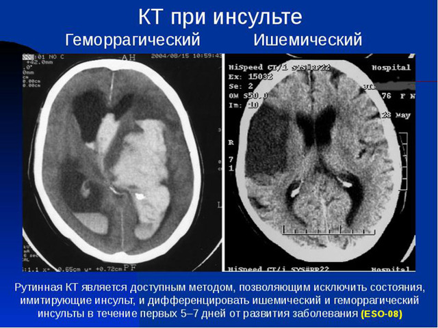 Инсульт: симптомы и признаки, причины развития, виды, как вести себя после инсульта