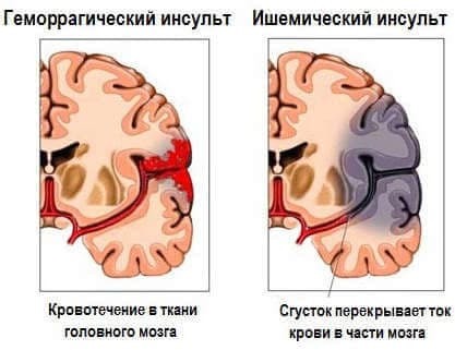 Инсульт: симптомы и признаки, причины развития, виды, как вести себя после инсульта