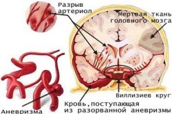 Инсульт: симптомы и признаки, причины развития, виды, как вести себя после инсульта