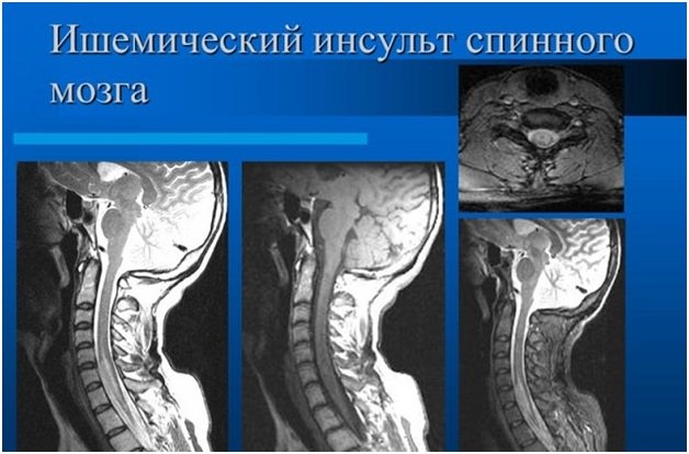 Инсульт спинного мозга, аорта позвоночника, симптомы кровоизлияния и прогноз