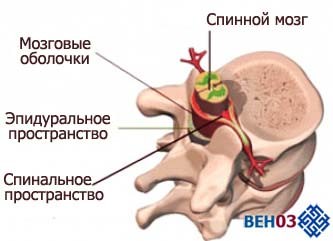 Инсульт спинного мозга, аорта позвоночника, симптомы кровоизлияния и прогноз