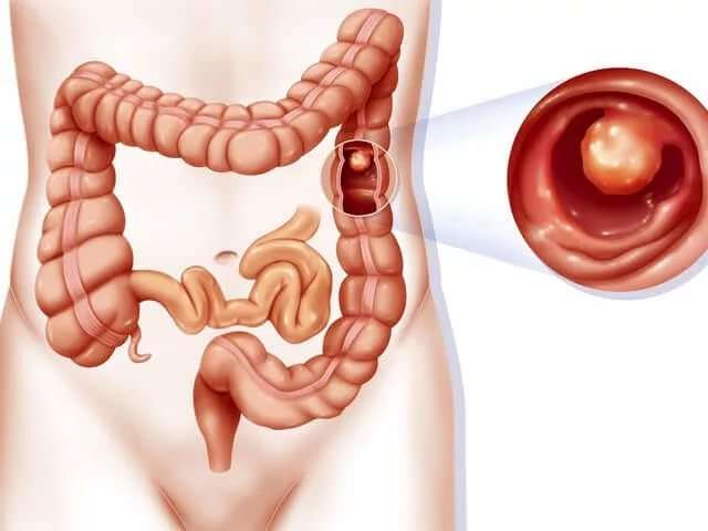 Ирригоскопия кишечника — что это такое, показания и противопоказания, как готовиться