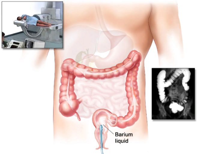 Ирригоскопия кишечника — что это такое, показания и противопоказания, как готовиться