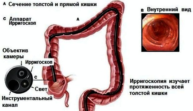 Ирригоскопия кишечника — что это такое, показания и противопоказания, как готовиться