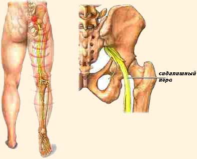 Ишиас &mdash; воспаление седалищного нерва: симптомы и лечение