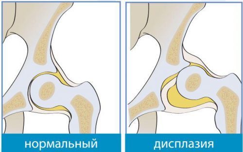 Искривление голеней у женщин, грудничков, новорожденных: причины, коррекция