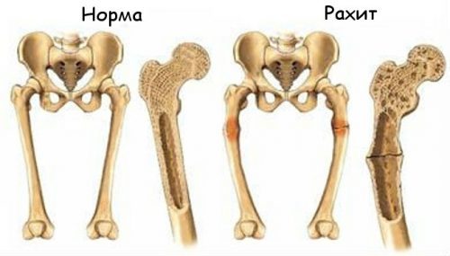 Искривление голеней у женщин, грудничков, новорожденных: причины, коррекция