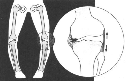 Искривление голеней у женщин, грудничков, новорожденных: причины, коррекция