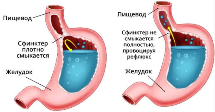 Изжога: как избавится в домашних условиях