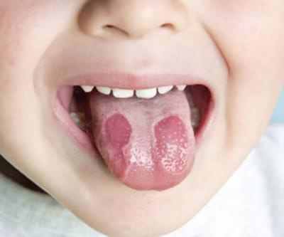Язвочки на языке у ребенка: 6 признаков и причин, симптомы, 7 методов лечения